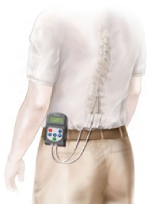 spinal cord stimulator horror stories