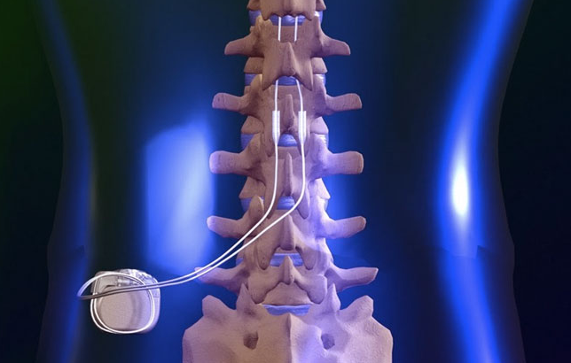 dorsal spinal column stimulator