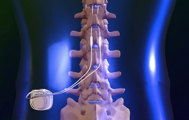 dorsal column stimulator for pain control